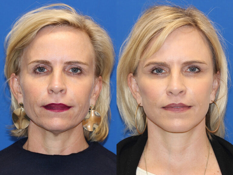 Amir Karam, MD discusses his innovative Vertical Restore procedure